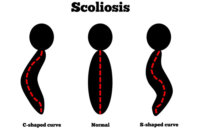 Boise, ID scoliosis treatment